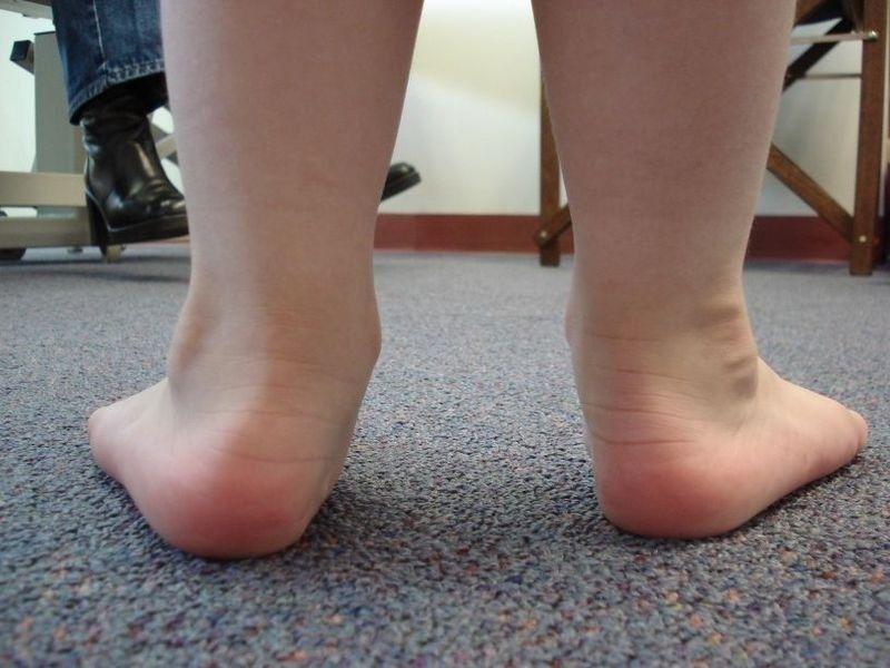 बच्चों में फ्लैट पैरों की पहचान कैसे करें &#8211; (Flat Foot Problem in Children in Hindi )