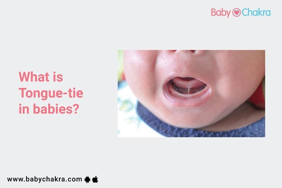 What Is Tongue-Tie In Babies?