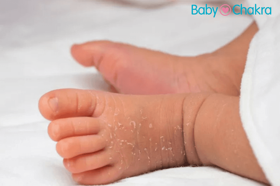 9 Effective Ways To Deal With Dry Skin In Babies 