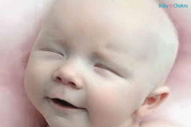 Albinism In Babies: What Are The Causes And Symptoms?