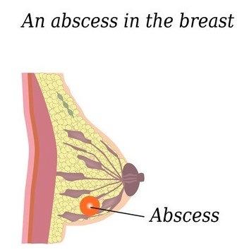 All About Breast Abscess During Lactation