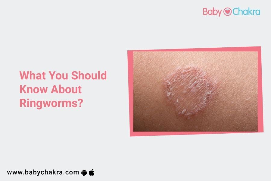 What Should You Know About Ringworm?