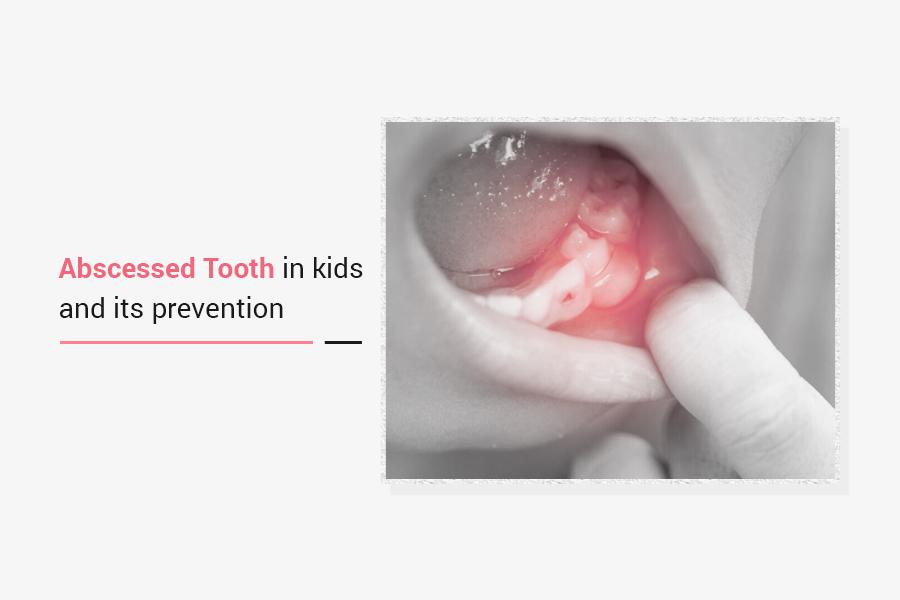 Abscessed Tooth In Kids And Its Prevention