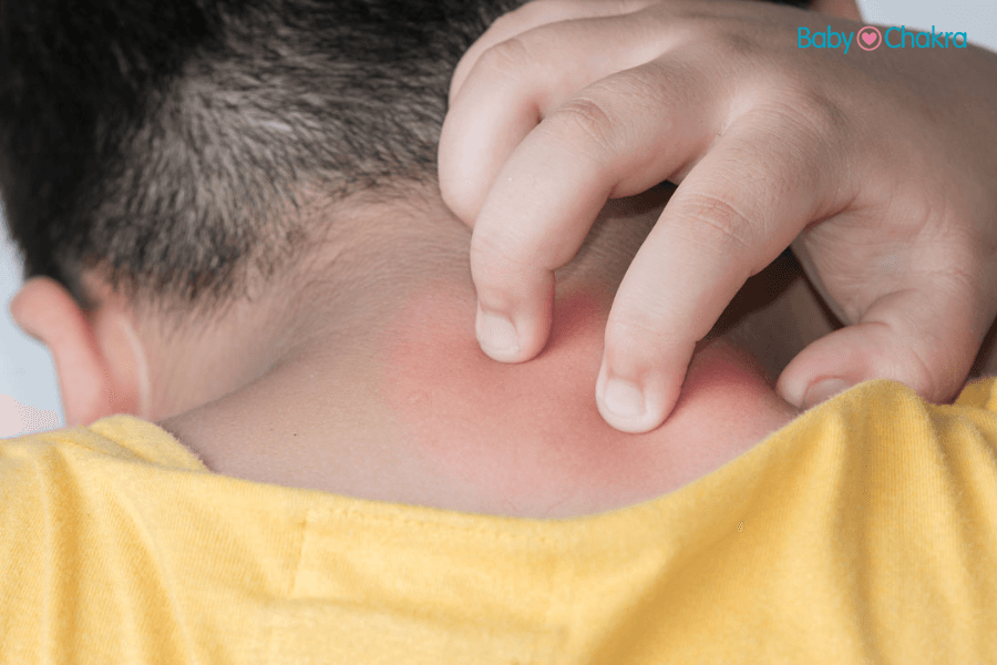 Common Outdoor Rashes In Children And Ways To Prevent Them