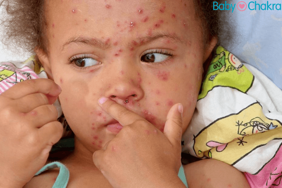 Measles In Kids: Causes, Symptoms, Prevention