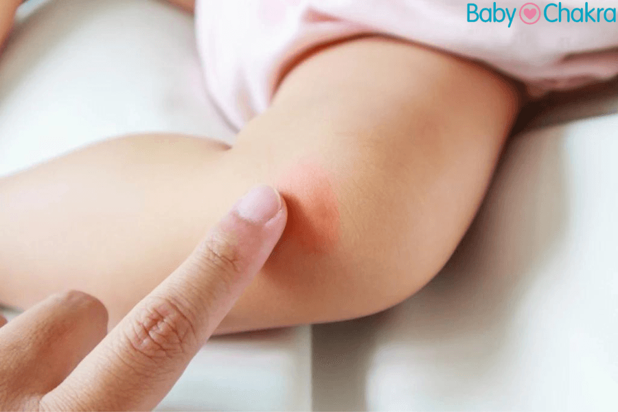 7 Natural Remedies For Mosquito Bites In Babies That Will Surprise You