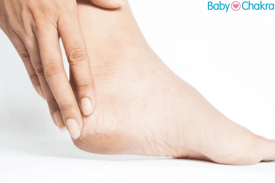 Keep Pregnancy Related Cracked Heels Away During Winter With These Natural Remedies