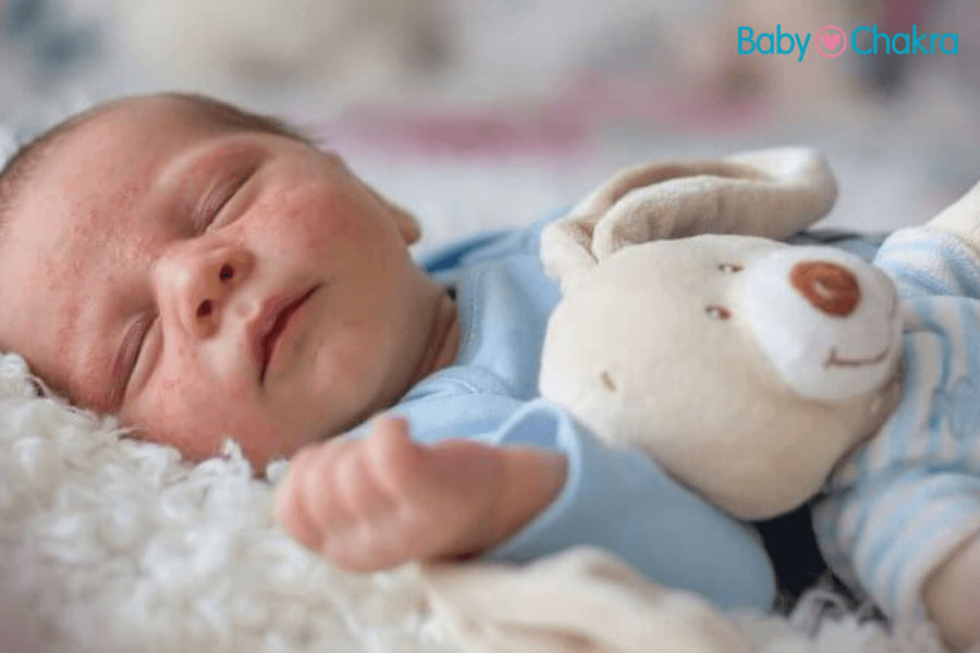 5 Precautions You Can Take To Avoid Eczema In Babies