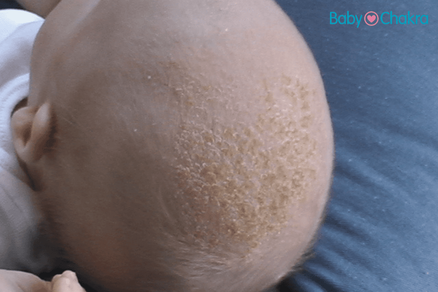 Cradle Cap In Winter: 3 Important Steps To Prevent And Manage It