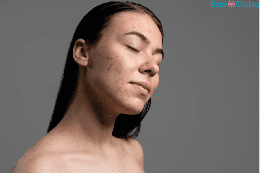 Here’s Why Your Brown Pigmentation Spots Aren&#8217;t Going Away