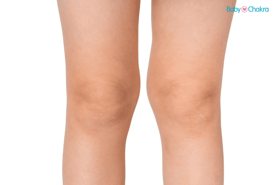 Knock Knees Exercises For Toddlers: Causes And Symptoms