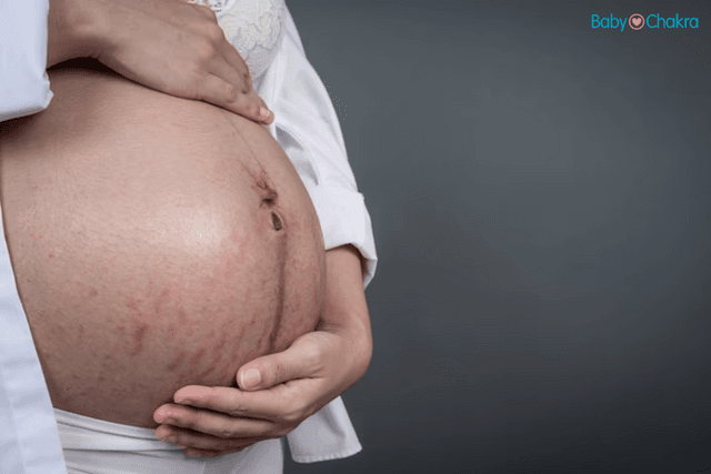 Varicose Veins In Belly During Pregnancy: Causes, Treatment, and Prevention