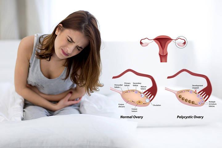 The Ultimate Guide on PolyCystic Ovarian Syndrome (PCOS): Part 1