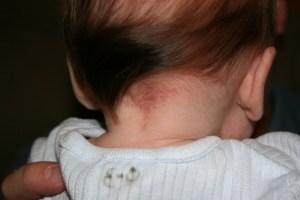 Different Types of Birthmarks
