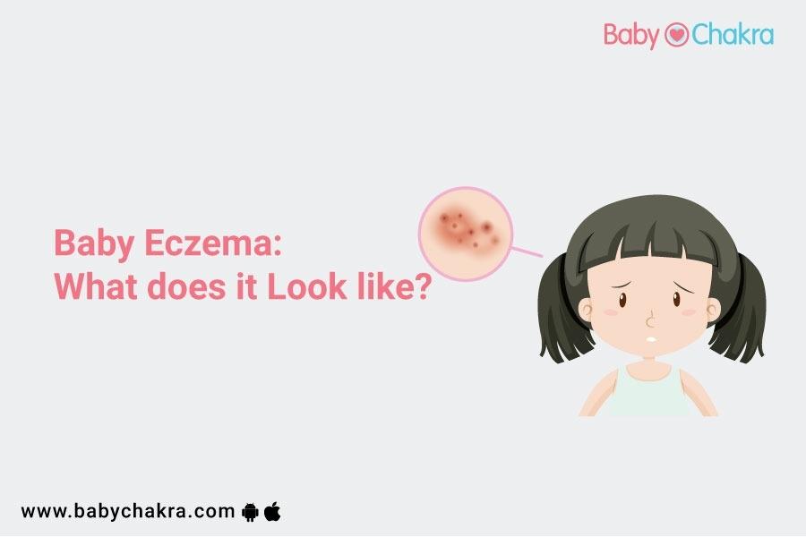 Baby Eczema: What Does It Look Like?