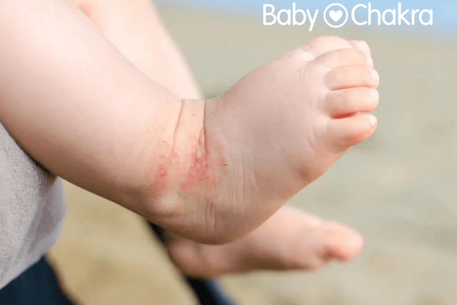 8 Natural Oils To Soothe Itchy Mosquito And Insect Bites In Babies
