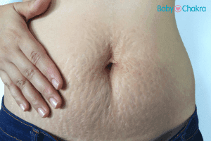 9 Ways To Reduce And Prevent Pregnancy Stretch Marks Naturally
