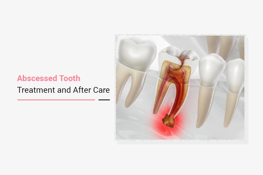 Abscessed Tooth Treatment And After Care