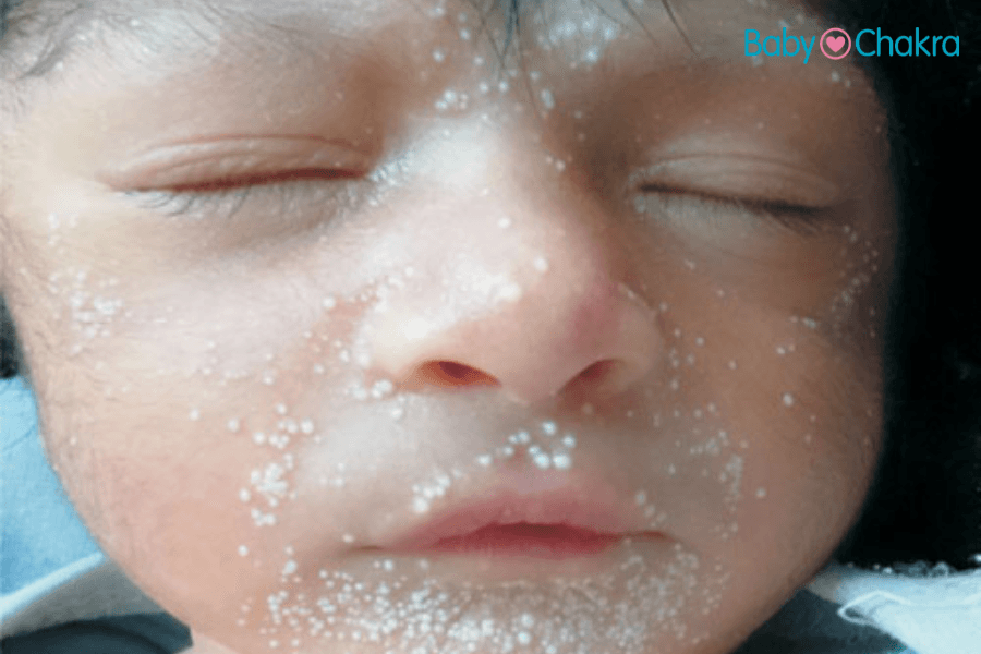 Milia In Newborn Babies: Dr. Soonu Udani Explain The Causes, Symptoms, And Treatment