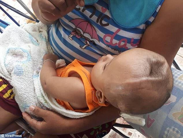 Abandoned Baby With 2 Inch Deep Skull Cavity Survives Xyz