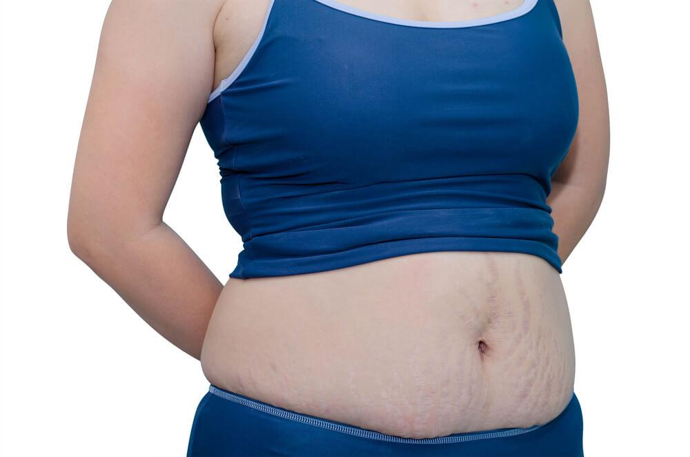 5 Ways To Get Rid Of Cellulite Post Pregnancy Xyz