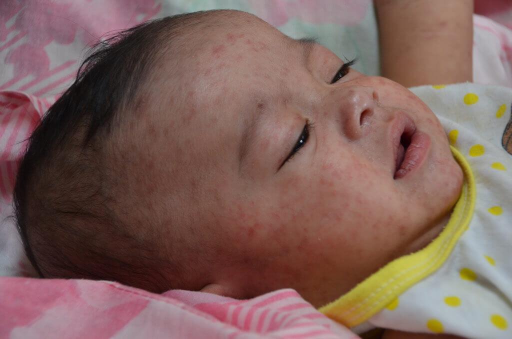 Dengue Fever In Babies Xyz