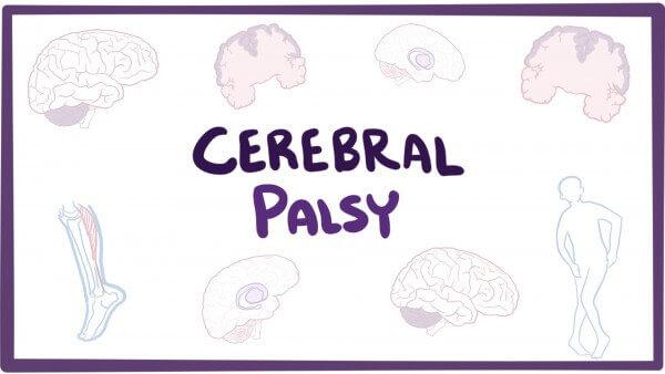 5 Facts About Cerebral Palsy You Ought To Know