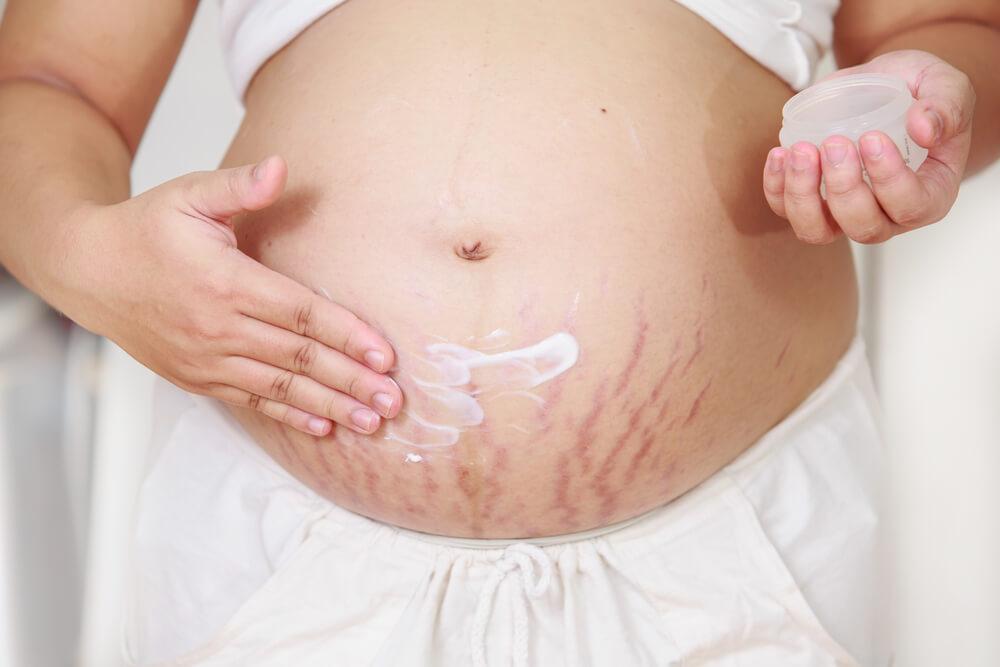 7 daily activities that affect stretch marks