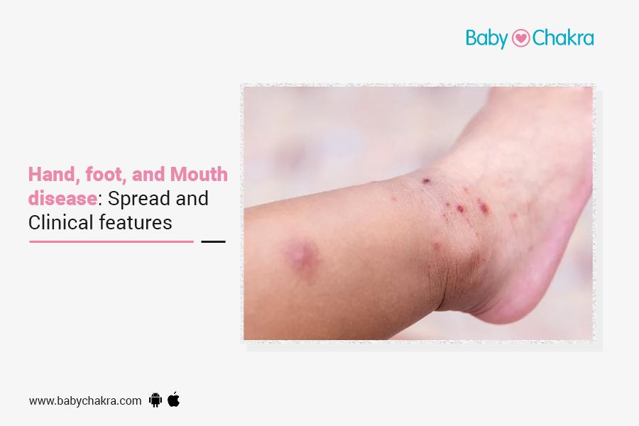 Hand, Foot, And Mouth Disease: Spread And Clinical Features