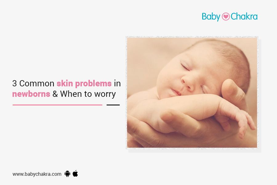 3 Common Skin Problems In Newborns & When To Worry