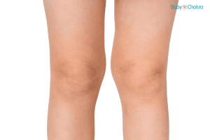 Knock Knees Exercises For Toddlers: Causes And Symptoms